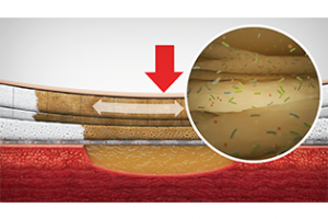 Mepilex dressings have five layers