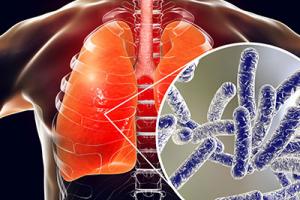 legionella in the lungs